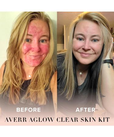 Averr Aglow - Clear Skin Kit - Acne Treatment - Dark Spot Remover - Blemish & Redness Control - Hydrating & Moisturizing - Rich in Minerals Antioxidants & Vitamin A C D & E - Skin Care - 4 pc Set - Buy Online on GoSupps.com