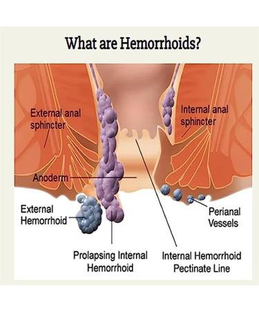 Heca Natural Herbal Hemorrhoid Treatment Capsules - Rapid Relief (3PCS) - Buy Online on GoSupps.com