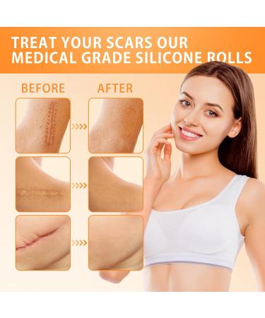 Silicone Scar Sheets | Scar Patches for C-Section Acne & Keloid Treatment - 1.6 x120  - Buy Online on GoSupps.com
