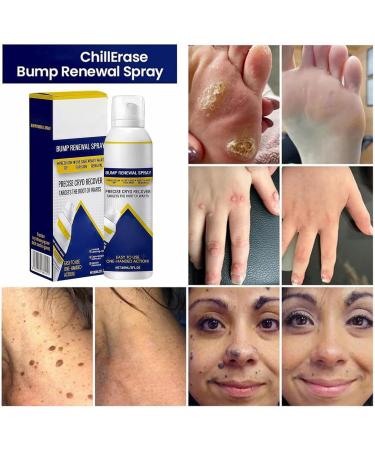  Bkljkf Soothing Spray for Skin Blemishes 60ml Natural Soothing Fast Absorbing Liquid Spray Care for Sensitive Skin for Women Men Teenagers and Young Adults - Buy Online on GoSupps.com
