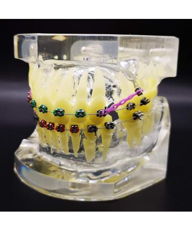 Dental Typodont Orthodontic Teeth Model with Metal Braces & Ligature Ties - Buy Online on GoSupps.com
