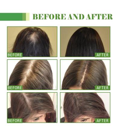 Hair Growth Oil Natural Hair Density Essential Oil Enhance Natural Hair Growth Intensity Repair Damaged Scalp and Hair No Scalp Irritation Hair Growth Serum for Hair Rapid Growth and Thickening - Buy Online on GoSupps.com