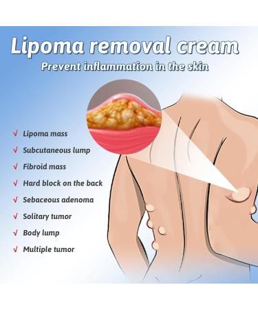 Lipoma Removal Cream Lipoma Elimination Cream Natural Herbal Lipoma Soothing Cream Effective Lipoma Care Cream Cream Relieve Varicose Veins Instant Tumor Removal Cream Skin Anti Swelling Cream - Buy Online on GoSupps.com