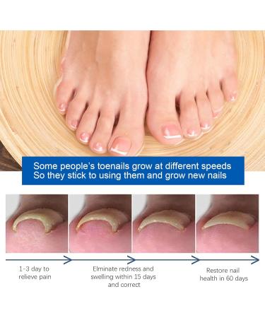Ingrown Toenail Treatment 30ml Ingrowing Toenail Treatment Toenail Anti Paronychia Relief Oil Correction Ingrown Toenail Softening Drops for Damaged Discolored Thick Nail - Buy Online on GoSupps.com