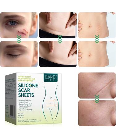 Silicone Scar Removal Foils - Effective Flattening for Surgery Burns Acne & More | 4cm x 300cm - Buy Online on GoSupps.com