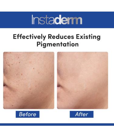Best Anti Aging Dark Spot Corrector Serum - Reduce Dark Spots Sun Spots & Acne Scars | Rejuvenate Skin Tone & Texture - Buy Online on GoSupps.com