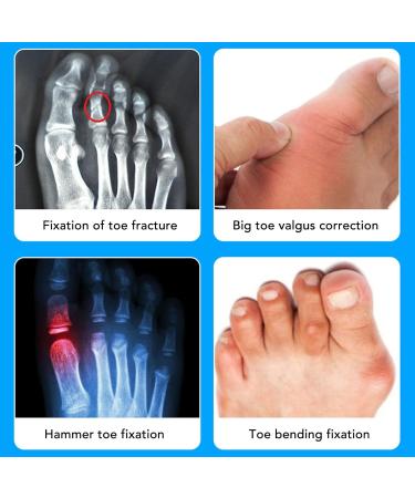 TMISHION Hammer Toe Straightener - Cushioned Bandage for Toe Straightening and Stress Reduction - Adjustable Claw Corrector for Right Foot - Buy Online on GoSupps.com
