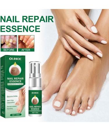 FASSME Nail Repair Essence toenail solution nail repair nursing solution of gray nails safe and effective repair discolored damaged nails 10ml - Buy Online on GoSupps.com