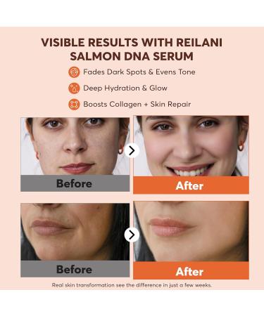 PDRN Salmon DNA Serum Anti-Aging Face Serum with Hyaluronic Acid Tripeptide & Vitamins (10 000ppm) Hydrating Facial Serum for Blemishes Collagen Boost & Fine Lines Korean Skincare 1 Fl Oz - Buy Online on GoSupps.com