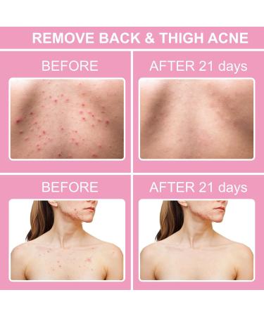 Body Acne Clearing Treatment Serum | Salicylic Acid & Tea Tree Oil | Clear Acne on Buttocks Thighs Back & Chest | 1.37 fl oz - Buy Online on GoSupps.com