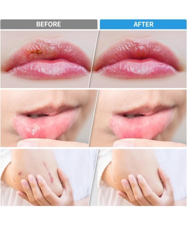 Lawind Cold Sore Treatment: Red Light Therapy for Pain Relief on Lips, Face, Body - Oral, Nose, Ear and Joint Inflammation Solution - Buy Online on GoSupps.com