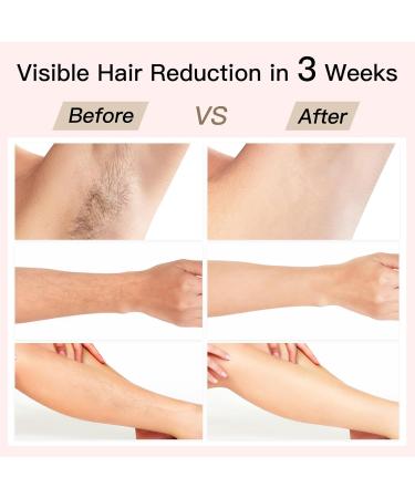 BoSidin IPL Laser Hair Removal Painless 2-in-1 Face Rejuvenation 6+1 Modes 6 Levels Permanent Hair Removal Kit for Women with Shaver & Goggles - Buy Online on GoSupps.com