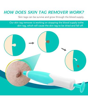 2 in 1 Skin Tag Remover Pen for Small to Large Skin Tags - Painless Wart Removal Device - Easy Tag Removal Kit - Green - Buy Online on GoSupps.com