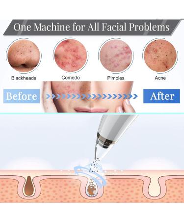 Blackhead Remover Pore Vacuum Cleaner with 5 Probes - Electric USB Facial Cleaner for Blackhead Suction - Upgraded Blackhead Remover Kit in Light White - Buy Online on GoSupps.com