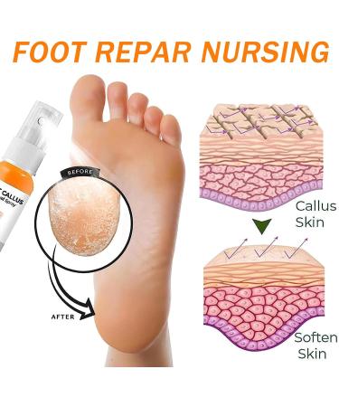 Foot Callus Removal Spray 2PCS - Instant Peel-Off Spray for Cracked Heels & Rough Skin - Orange Oil Hydrating Formula for Nourished Feet - Buy Online on GoSupps.com