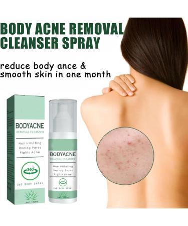 Acne Treatment Spary Back Acne Treatment Serum Body Moisturiser For Acne Body Moisturiser For Dry Skin Acne Moisturiser Reduce Back Acne & Body Acne Smoothing Moisturiser For Acne Prone Skin-120ml - Buy Online on GoSupps.com