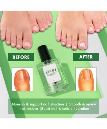 Ingrown Toenail Kit SKINAPEEL Toe Nail Softener and Ingrown Toenail Treatment Oil PLUS Ingrown Toenail Tool Correction Clamp & Double Ended Corrector Tool - Buy Online on GoSupps.com