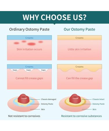 Ostomy Filler Paste 2 oz - Stoma Skin Barrier Paste for Safe & Secure Ostomy Care | Buy Ostomy Supplies Online - Buy Online on GoSupps.com