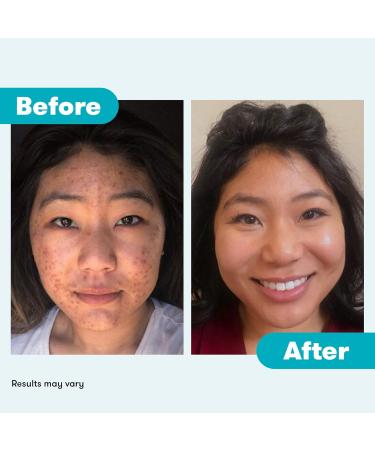 Proactiv+ 3 Step Advanced Skin Care Acne Treatment - Benzoyl Peroxide Face Wash Exfoliating Face Wash And Pore Minimizer - 30 Day Complete Acne Skin Care Kit - Buy Online on GoSupps.com