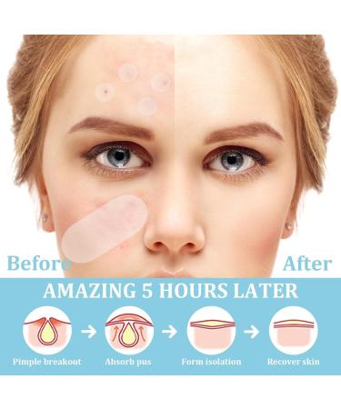 Hydrocolloid Patches (80 Patches) Acne Pimple Spot Patch for Large Zit Breakoutse Face Chin and Body Mighty Dots for Spots Treatment with Tea Tree & Calendula Oil Hydrocolloid - Buy Online on GoSupps.com