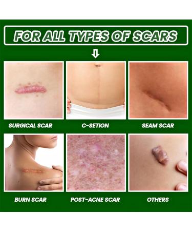 Natural Aloe Vera Scar Cream 20g Helps Soothe Acne Scars C-Section Scars Burns And Surgery Scars Works On Both Old And New Scars - Buy Online on GoSupps.com