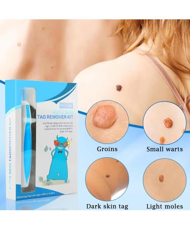 Ultimate Skin Tag Remover Kit | Fast & Effective Warten Removal Tool for Fibroma & Wart Treatment | 60 Skin Tags (1mm-8mm) - International Shipping Available - Buy Online on GoSupps.com