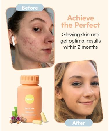 Ovira Skin Clear with ZINCBRIGHT - 60 Capsules for Clear and Glowing Skin | Rosacea & Hormonal Acne Treatment | Support Collagen Production | Acne Supplements for Women & Men - Pack of 2 60 Count (Pack of 2) - Buy Online on GoSupps.com
