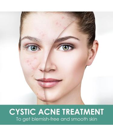 Cystic Acne Treatment: Effective Hormonal Acne Cream for Face | Acne Treatment - Buy Online on GoSupps.com