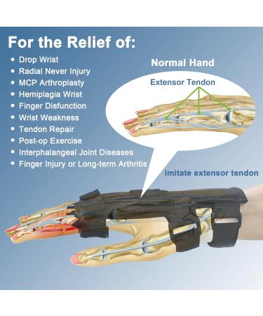 Adjustable Radial Nerve Palsy Splint & Finger Extension Brace for Drop Wrist - Fits Left & Right Hand - Buy Online on GoSupps.com