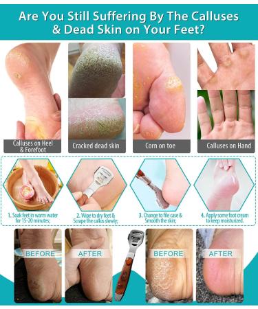 15Pcs Callus Shaver & Remover for Feet - Foot Razor Blade Pedicure Tools with 10 Blades, Storage Box & Carry Pouch - Buy Online on GoSupps.com