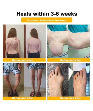 Luhaka Botulinum Toxin & Bee Venom Pain-Relief Bone Healing Cream Bee Venom Cream Effectively improve joint mobility (1PC) - Buy Online on GoSupps.com