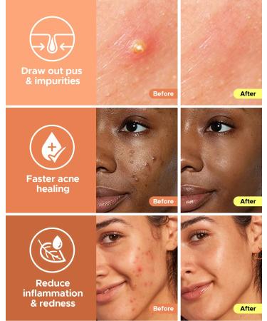 LitBear Acne Patch - Hydrocolloid Star Shaped Pimple Absorbing Cover (Orange & Yellow) 112 Count - Buy Online on GoSupps.com