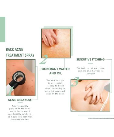 Back acne treatment herbal spray acne relieves spary back acne spray for chest and back back peeling deeply cleanses the body of excess oil gently applied to the skin - Buy Online on GoSupps.com
