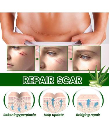 Scar Gel | Natural Calming Moisturizing Aloe Gel for Skin Lightening - Professional Scar Eraser Non-greasy Scar Repair Skin Care for Wounds Sysdisen - Buy Online on GoSupps.com