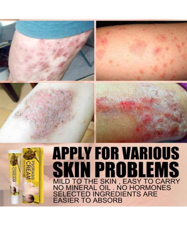 VEJIA Eczema Psoriasis Treatment Cream 20g - Dermatitis Pruritus Relief Ointment for Adults (3pcs) - Buy Online on GoSupps.com