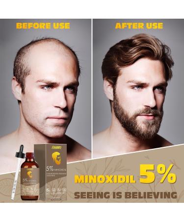 SALUBRITO 5% Biotin Minoxidil Hair Growth Oil 120ML - Hair Loss Treatment for Men & Women - Thickening & Regrowth Serum - Two Months Supply - Buy Online on GoSupps.com