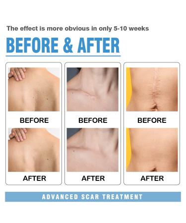 Carbou Medical Silicone Scar Tape 1.6x120 | Painless Scar Removal for C-Section, Surgery, Acne & Keloid - Buy Online on GoSupps.com