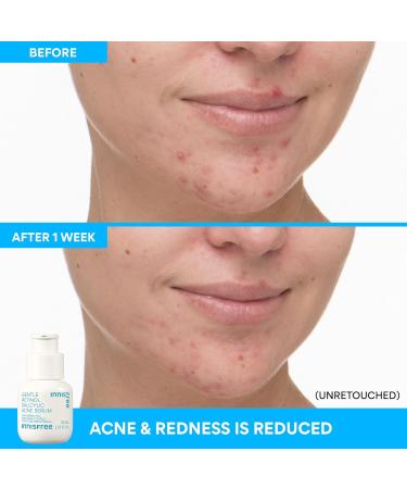 innisfree Gentle Retinol Salicylic Acne Serum Korean Face Treatment for Blemishes and Clear Skin - Buy Online on GoSupps.com