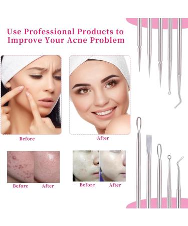5PCS Blackhead Remover Kit - Professional Stainless Steel Pimple Popper & Comedone Extractor Tool for Nose & Facial - Blemish Extraction Tool Set - Buy Online on GoSupps.com