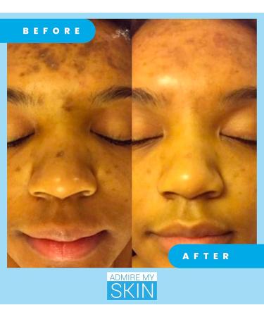 Admire My Skin Dark Spot Corrector Serum + Retinoid Cream Set - Buy Online on GoSupps.com