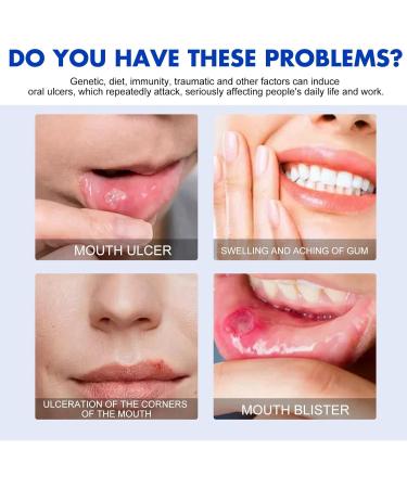 Oral Ulcer Sprays Mouth Ulcer Treatment Spray Ulcer Breath Sprays Mouth Ulcer Spray Canker Relief Spray Ulcer Treatment Tongue Herbal Mouth Spray Breath Freshener Spray Effective Canker Sore Treatment - Buy Online on GoSupps.com