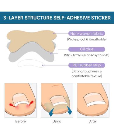 Ingrown Toenail Treatment: Professional, Safe, and Painless Corrector Strips - 50Pcs - Buy Online on GoSupps.com