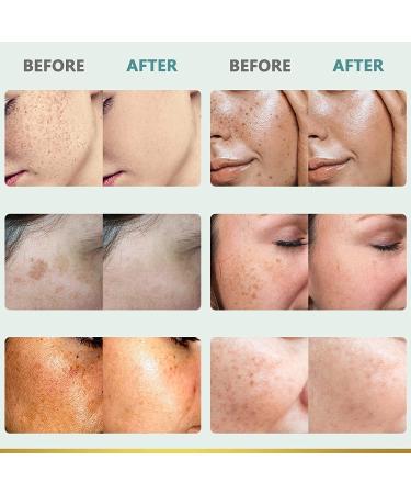 Dark Spot Remover for Face - 3PCS Dark Spot Corrector Cream for All Skin Tones - Melasma, Freckle, Sun Spot Remover & Blemish Reducer 2.1 FL OZ - Buy Online on GoSupps.com