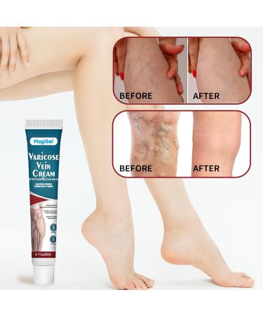  MagiSel Varicose Vein Cream Spider Leg Repair Cream Vein Soothing Cream Relieves Tired and Heavy Legs Soothes and Moisturizes 20g - Buy Online on GoSupps.com