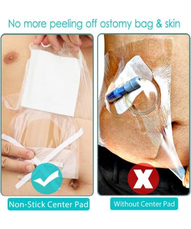 25 Pcs Waterproof Stoma Shower Cover 9x9 - Ostomy Bag Protector Shield Film Bandage - Colostomy Pouch Supply Bath Guard Accessory 9x9 inch - Buy Online on GoSupps.com