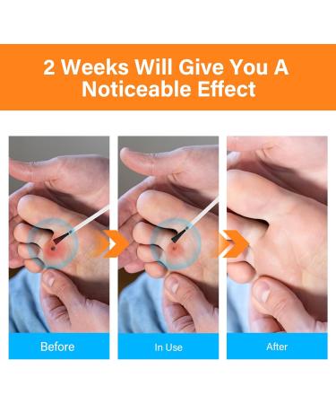 Corn-Remover-for-Feet 30ml Effect Corn Removal Liquid - Buy Online on GoSupps.com