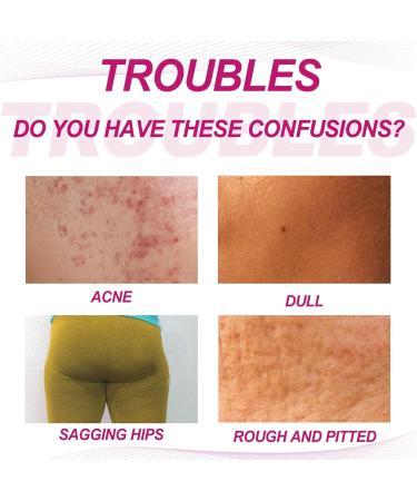 Mikabila (06)100ml Butt Acne Clearing Cream Anti-Acne Buttocks & Thigh Treatment Butt Acne Clearing Cream Back & Thigh Acne Cream Treatment for Acne Butt Pimple Clearing Treatment Cream - Buy Online on GoSupps.com