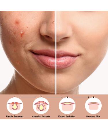 AINA Hydrocolloid Pimple Patches - Invisible Acne Spot Dots | Clear Natural Zit Patches | 48 Dots + Bonus Chin & Nose Patches - Buy Online on GoSupps.com