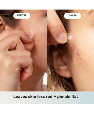 WKND COSMETICS Pimple Patches 48 Count - Hydrocolloid Acne Treatment for Fast Healing - Gentle Blemish Care Face Acne Dots & Zit Stickers for Clear Skin - Play Zit Patch 48 Count - Buy Online on GoSupps.com