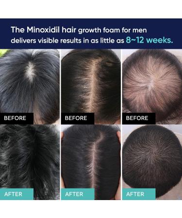 Men's 5% Minoxidil Foam Hair Regrowth Treatment with Brush - 60g | 1-Month Supply - Buy Online on GoSupps.com